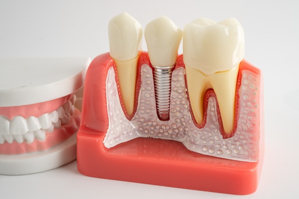 When You May Need Dental Core Buildup Before A Dental Crown