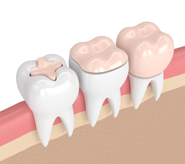 Miami Dental Inlays and Onlays